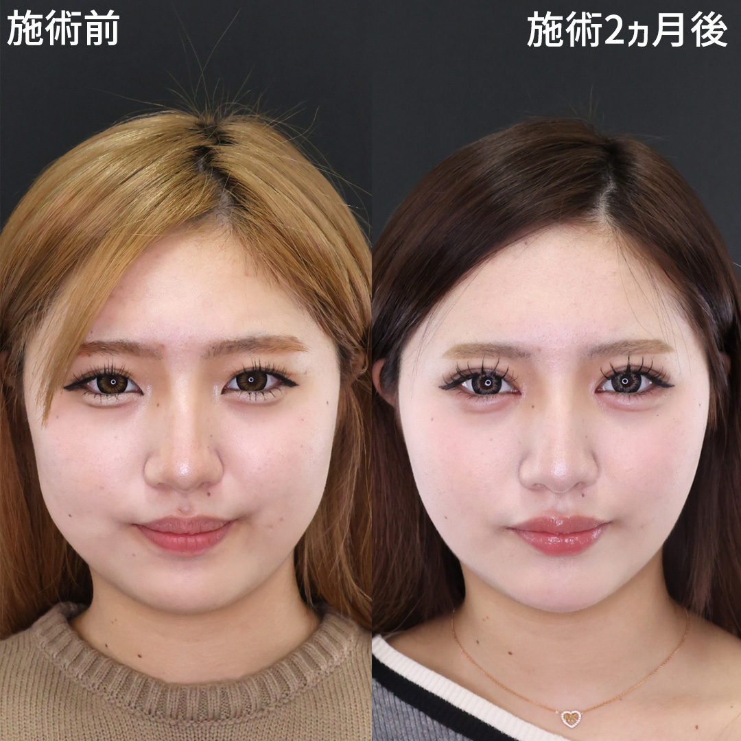 さらに可愛く 10代の「目元×小顔」整形で盛れる私へ