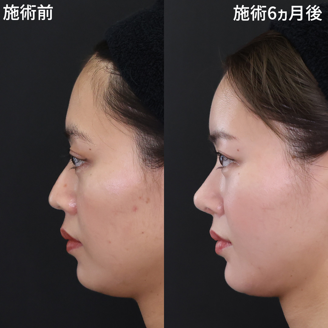 美しいS字カーブを作る Dr.古川の鼻整形×脂肪注入