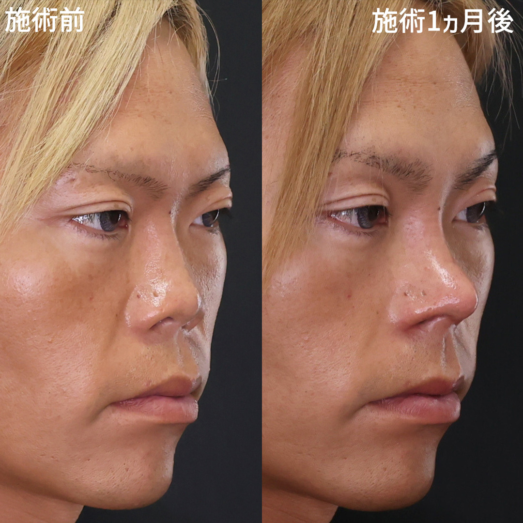 ～顔の印象は「鼻」で決まる～ 顔全体の印象を変える 男を上げる鼻整形