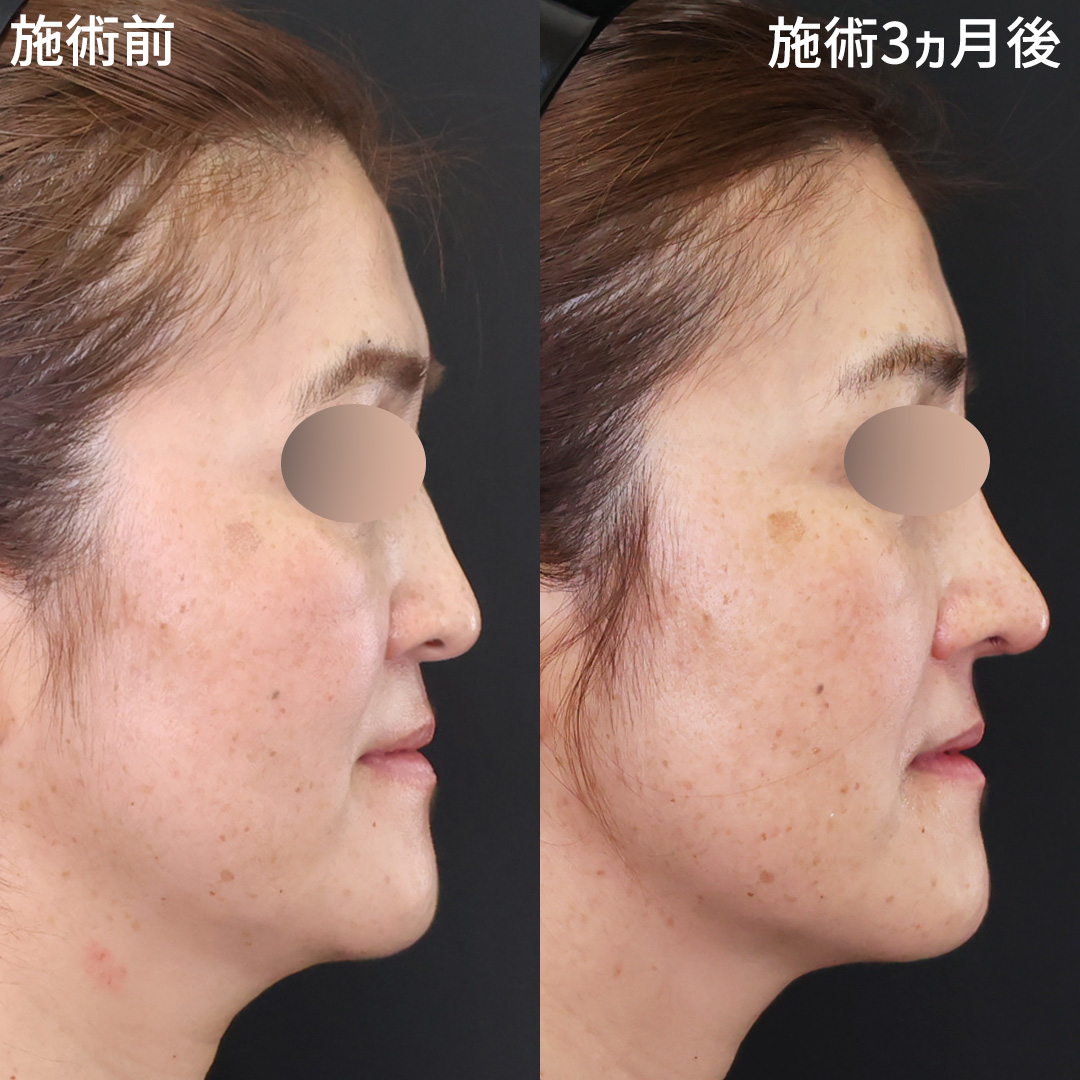 50代、過去最高の自分になる Eライン整う鼻整形