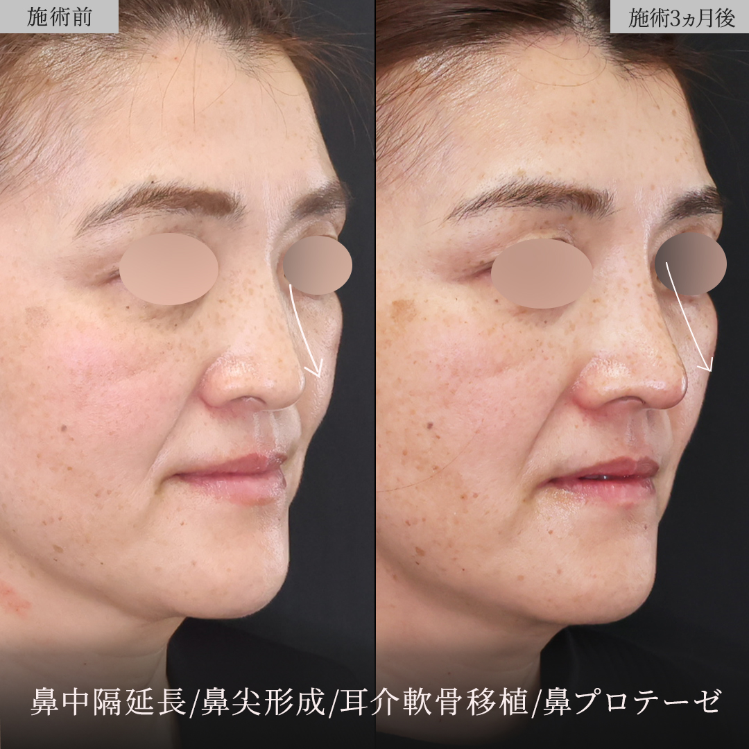 鼻中隔延長術/鼻尖形成・鼻尖縮小/鼻先軟骨移植の症例写真 施術前後 