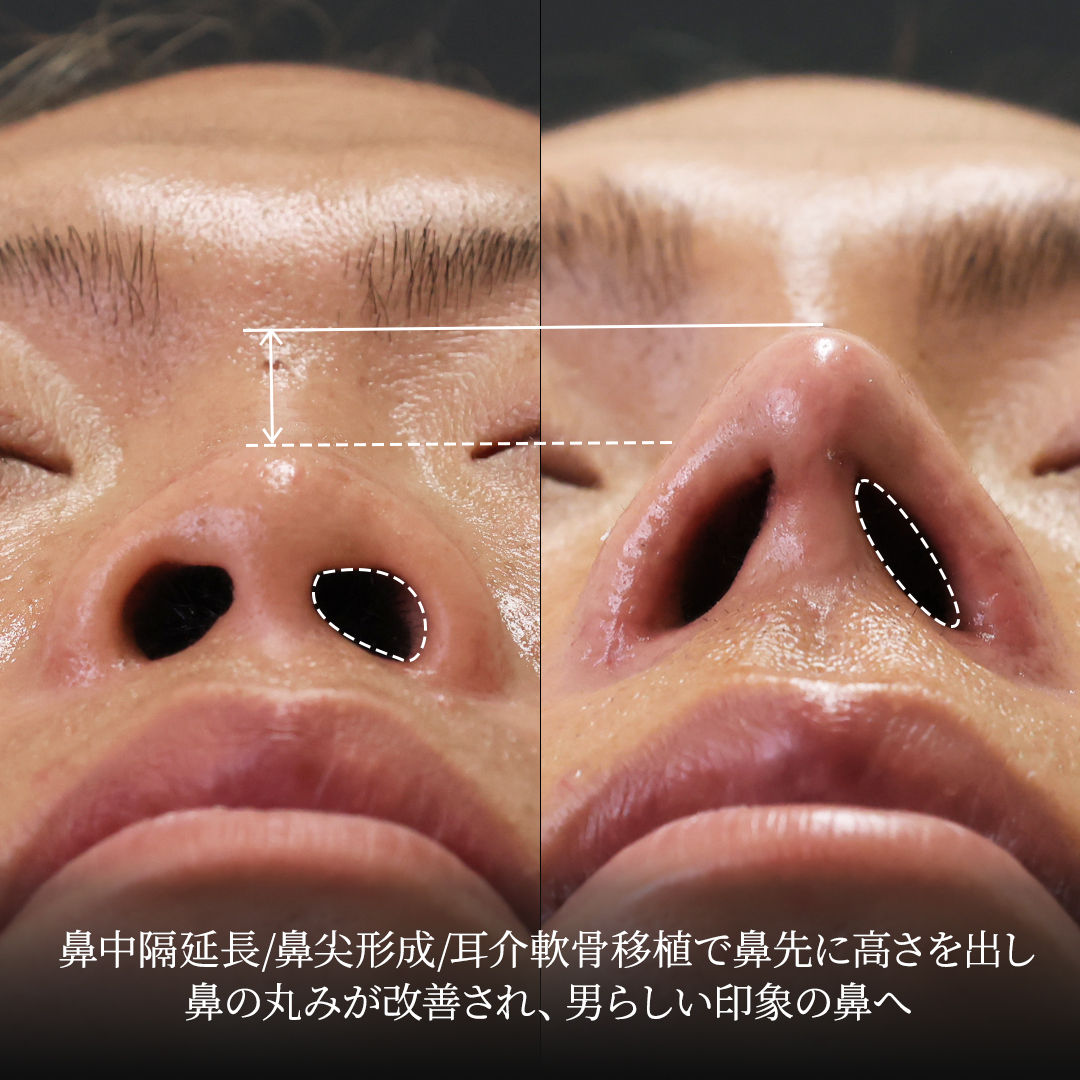 鼻中隔延長術/鼻尖形成・鼻尖縮小/隆鼻術（プロテーゼ・自家組織）の症例写真 施術前後 