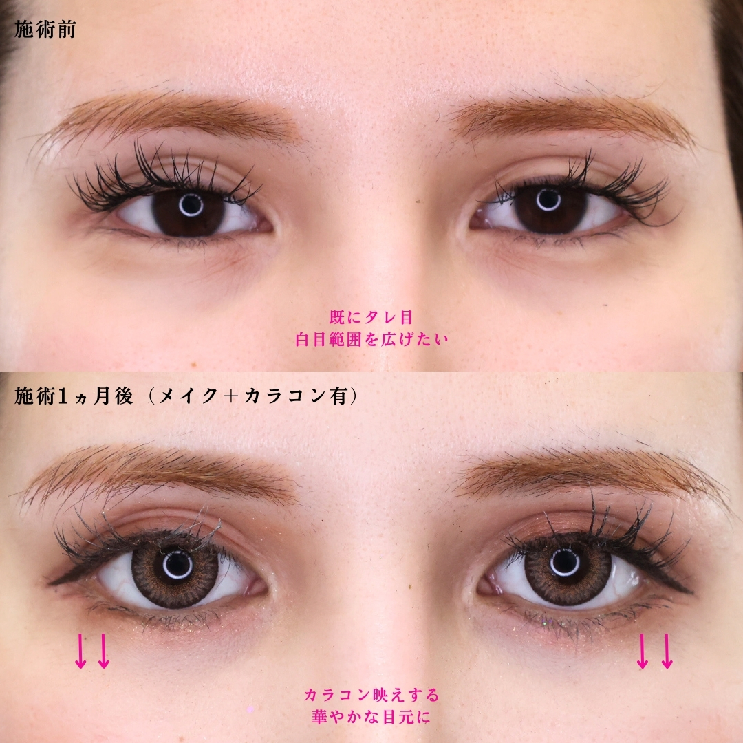 グラマラスライン（タレ目形成）の症例写真 施術前後 