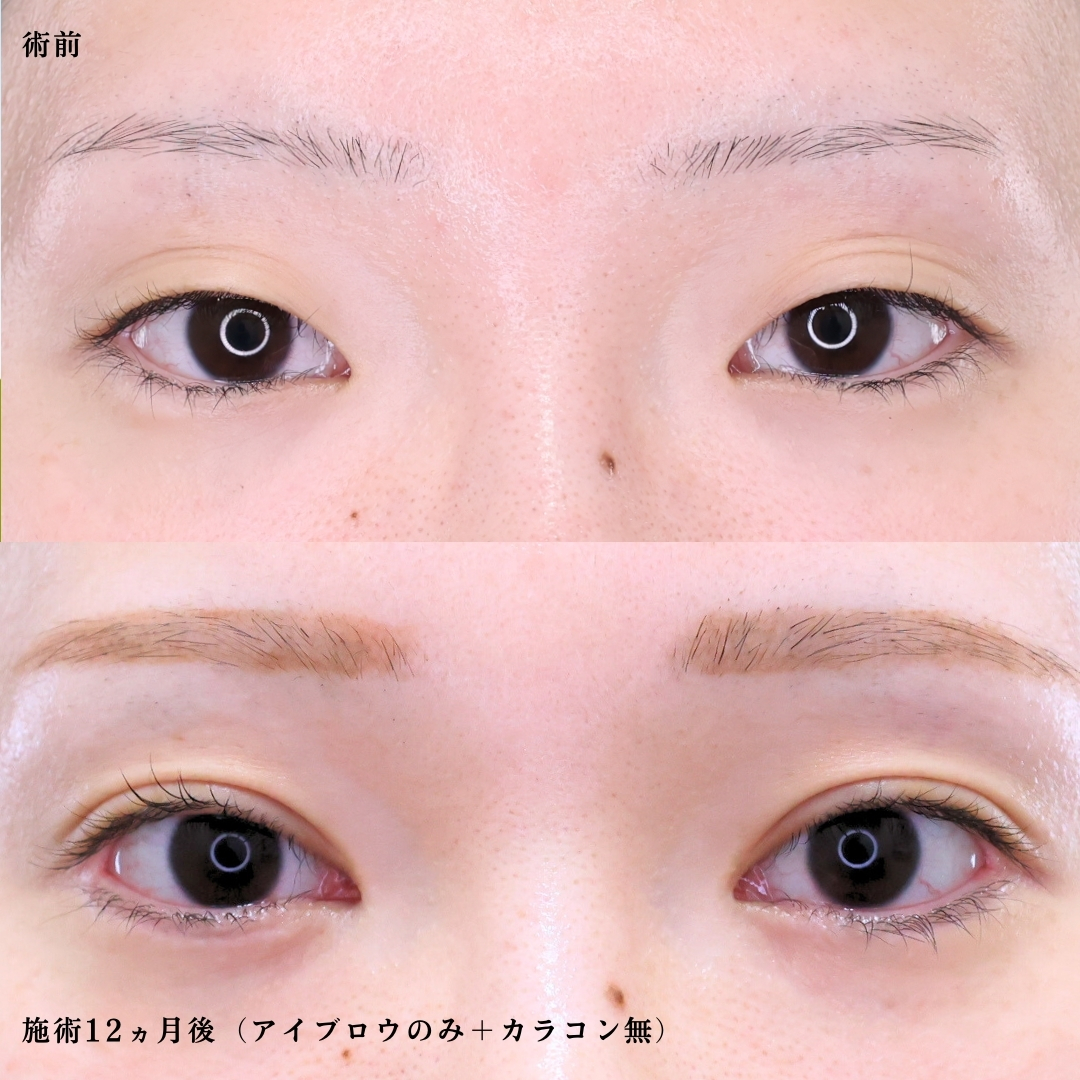 二重埋没法/目頭切開術/目尻切開術の症例写真 施術前後 