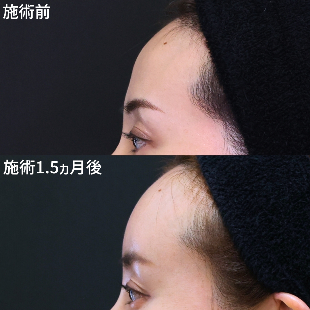 丸いおでこが若見えの秘訣　Dr.古川→おでこの脂肪注入