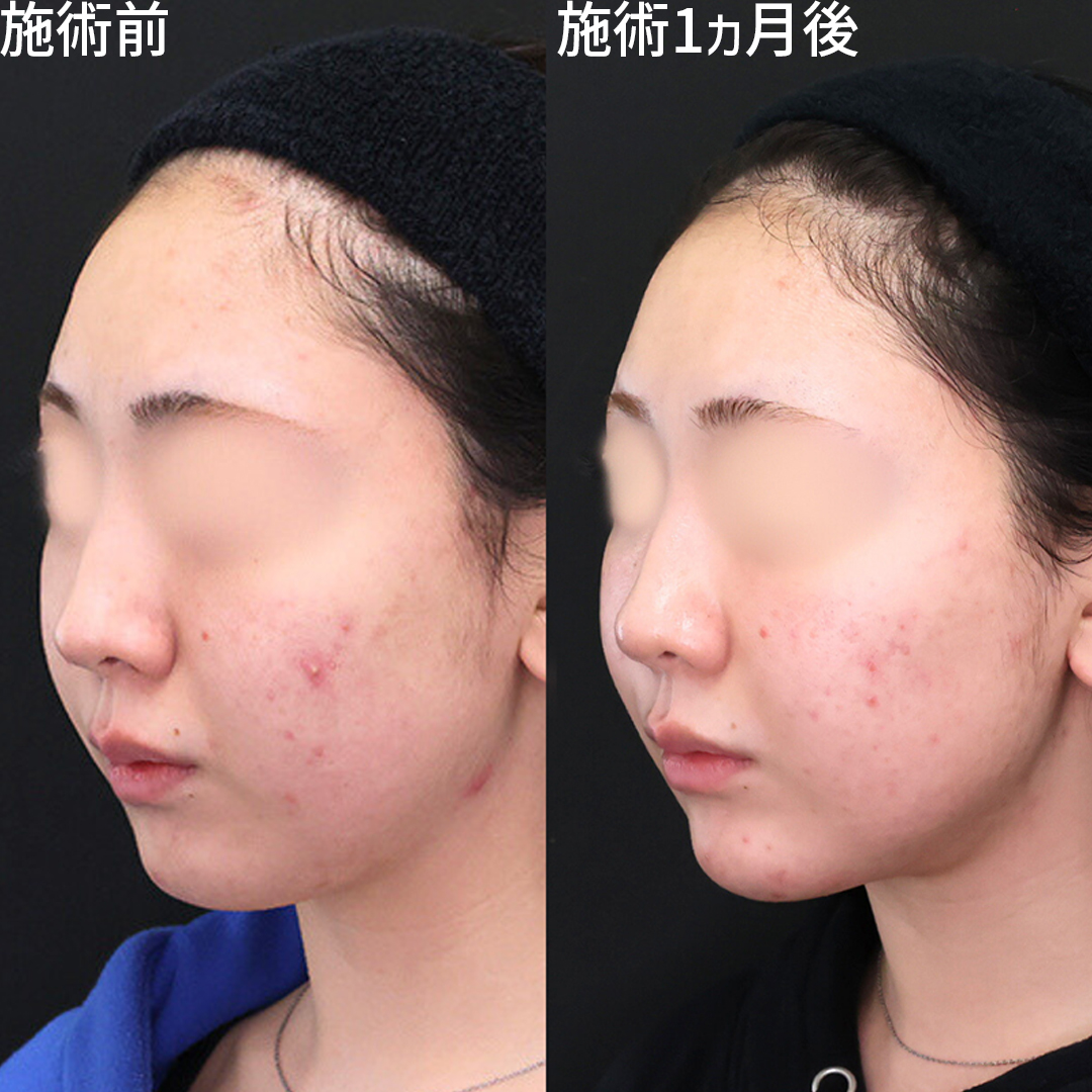 お顔の脂肪を除去して理想のフェイスラインに!