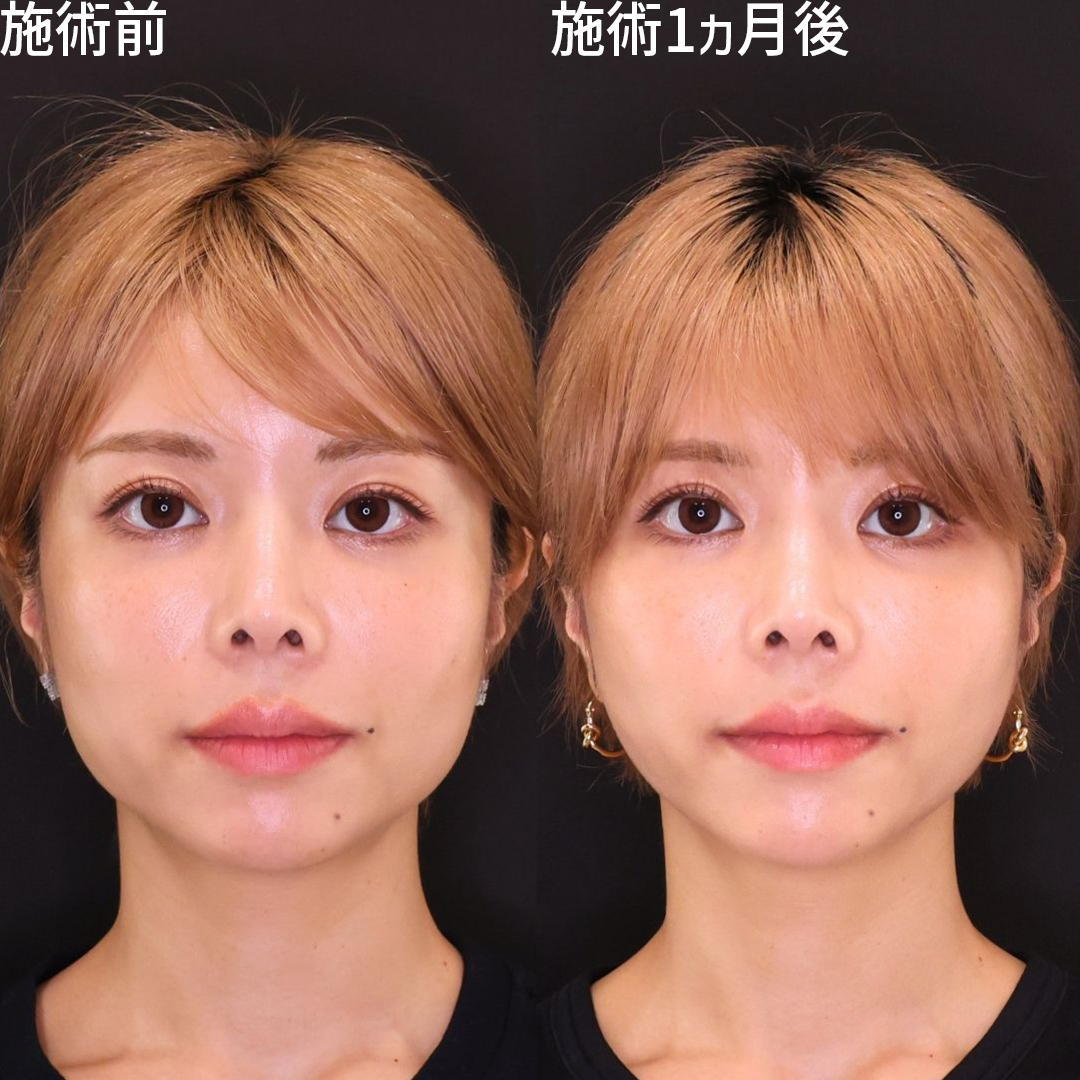 顔の余白を減らして加工いらずのフェイスラインに