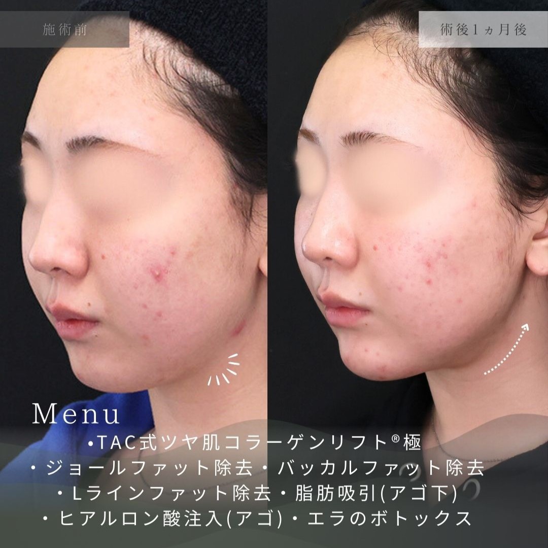 TAC式 ツヤ肌コラーゲンリフト®/バッカルファット除去/ジョールファット除去の症例写真 施術前後 