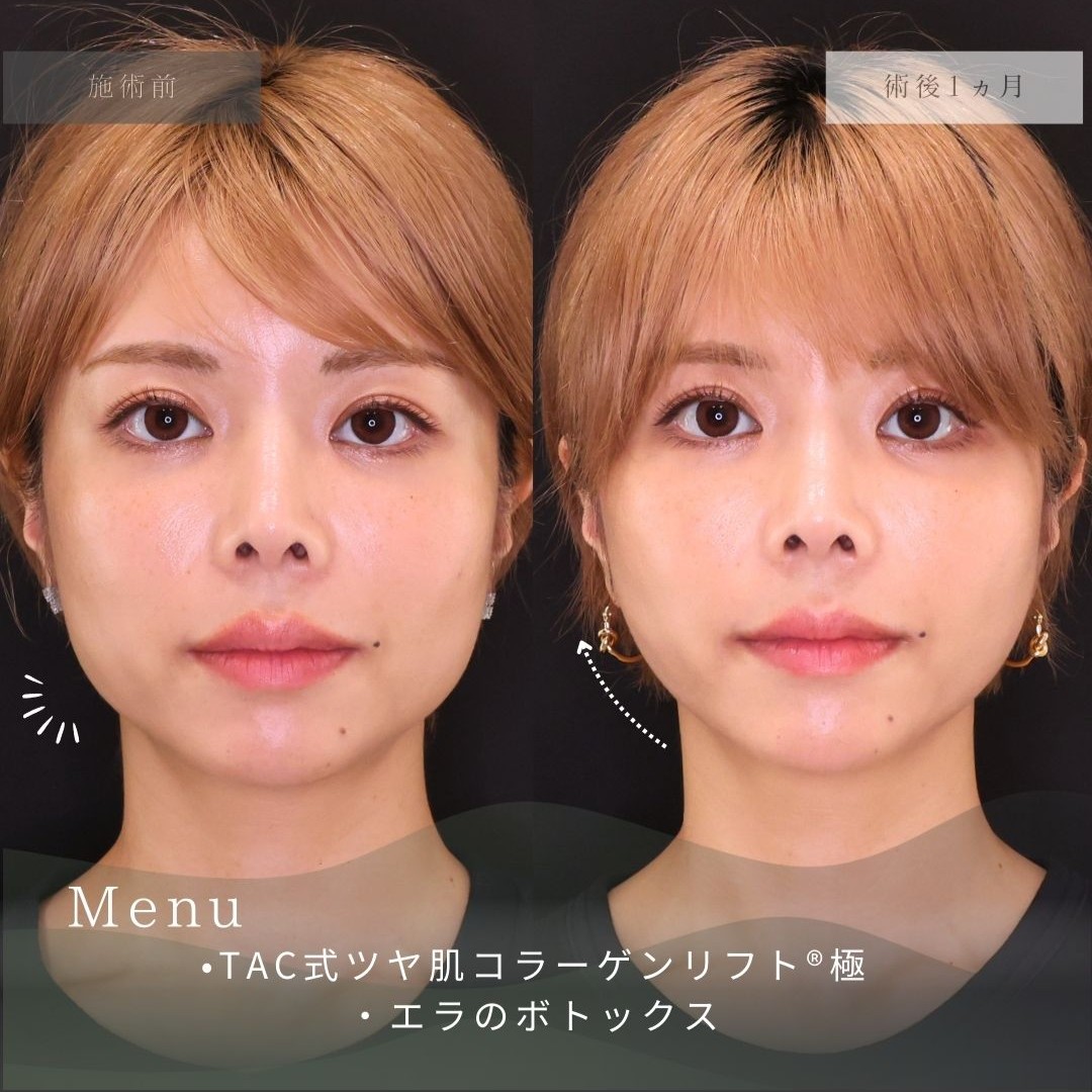 TAC式 ツヤ肌コラーゲンリフト®/エラボトックス注射の症例写真 施術前後 