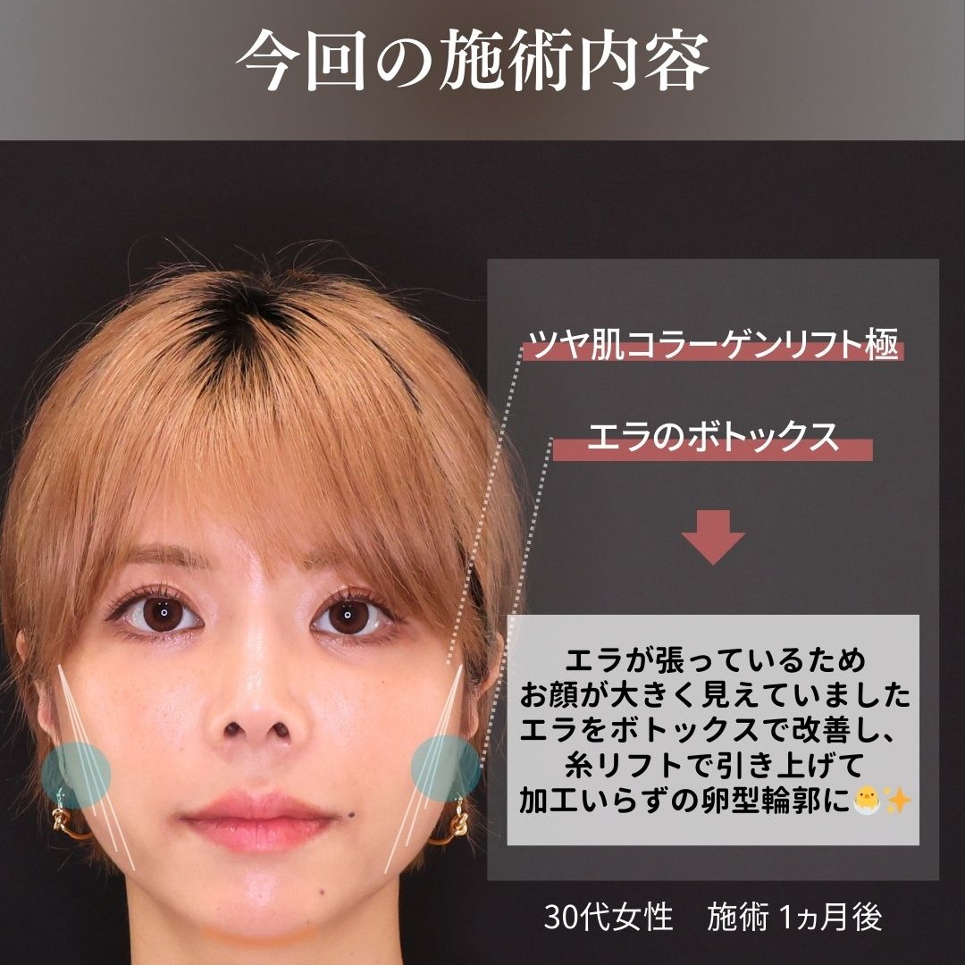 TAC式 ツヤ肌コラーゲンリフト®/エラボトックス注射の症例写真 施術前後 