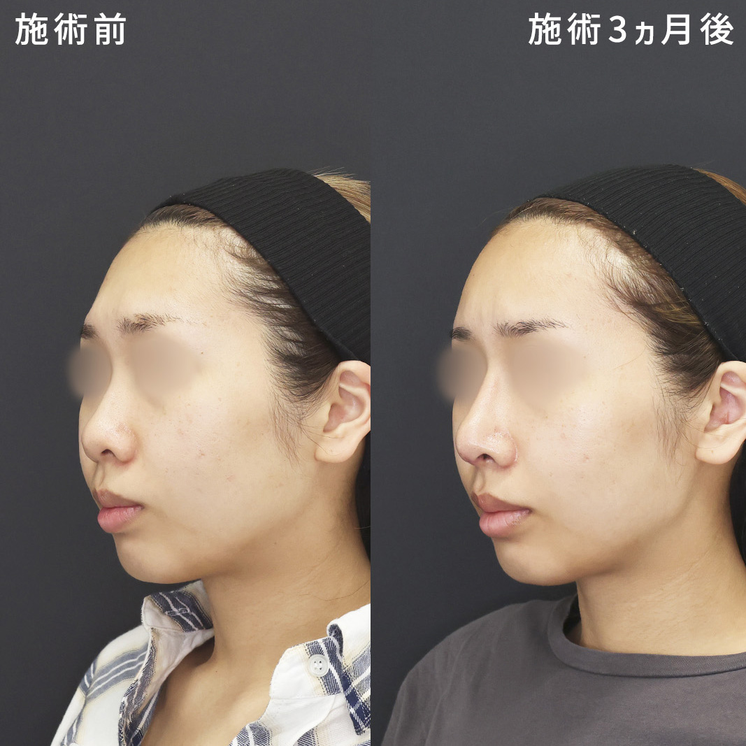 《鼻フル×額の脂肪注入》鼻先を下に下げ、Ｓ字ラインを形成