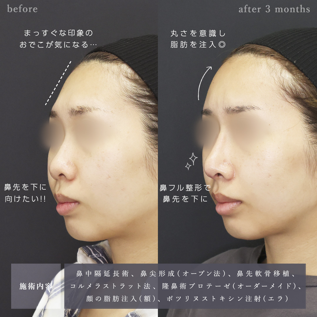 鼻中隔延長術/おでこの脂肪注入（オルチャンデコ形成）/顔の脂肪注入(コンデンスリッチフェイス)の症例写真 施術前後 