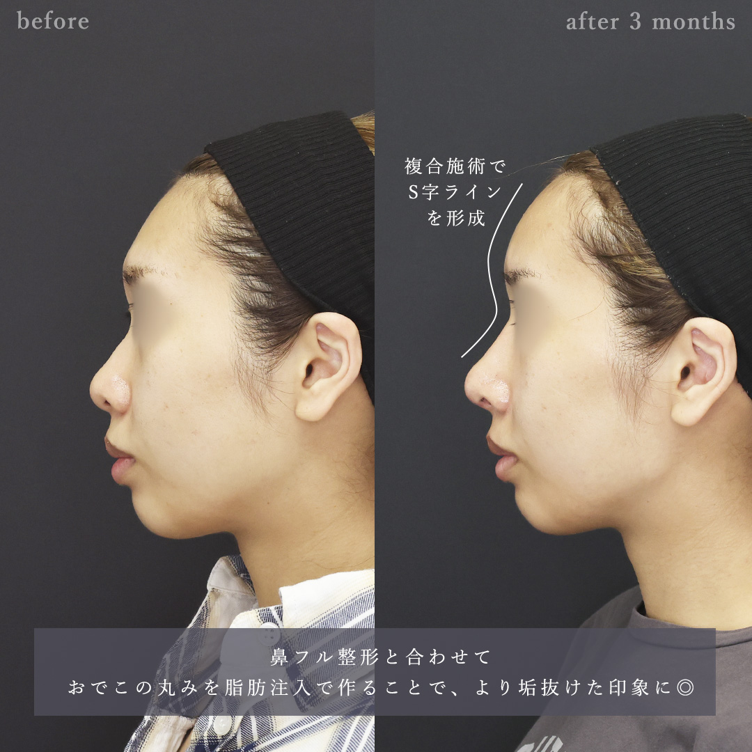 鼻中隔延長術/おでこの脂肪注入（オルチャンデコ形成）/顔の脂肪注入(コンデンスリッチフェイス)の症例写真 施術前後 