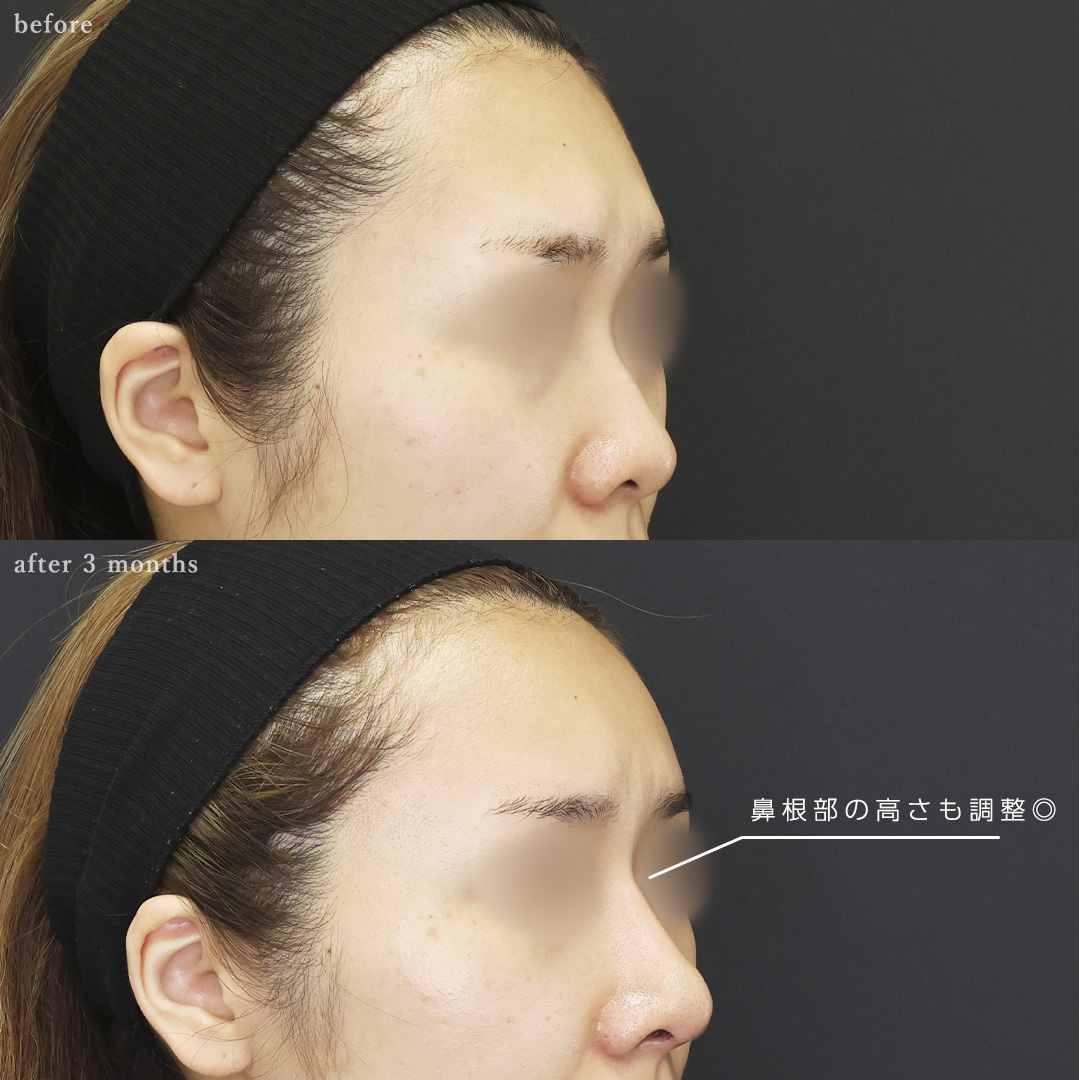 鼻中隔延長術/おでこの脂肪注入（オルチャンデコ形成）/顔の脂肪注入(コンデンスリッチフェイス)の症例写真 施術前後 