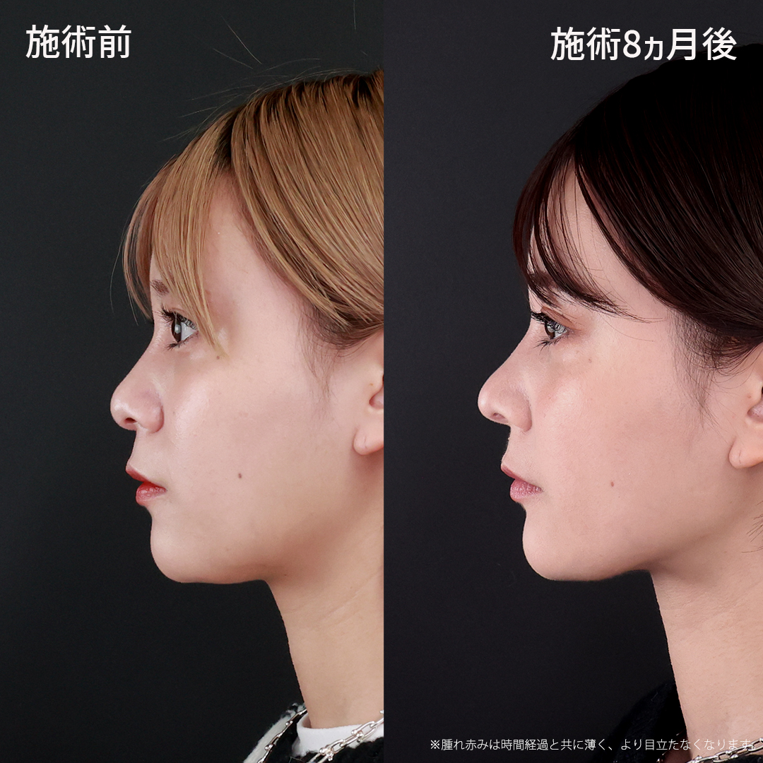 【鼻整形】小鼻×鼻先を美しく変える、美鼻整形