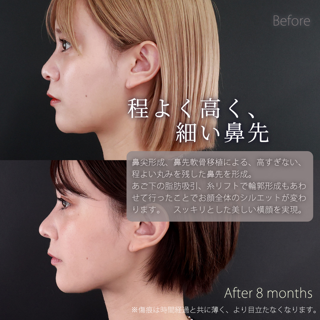 鼻中隔延長術/鼻先軟骨移植/鼻尖形成・鼻尖縮小の症例写真 施術前後 