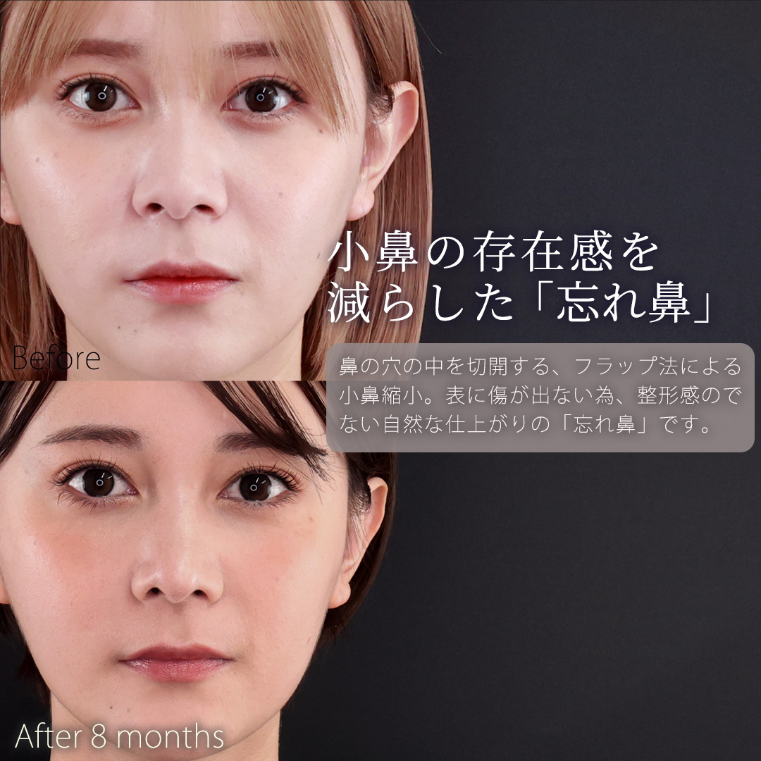 鼻中隔延長術/鼻先軟骨移植/鼻尖形成・鼻尖縮小の症例写真 施術前後 