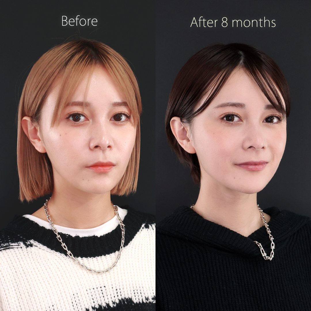 鼻中隔延長術/鼻先軟骨移植/鼻尖形成・鼻尖縮小の症例写真 施術前後 