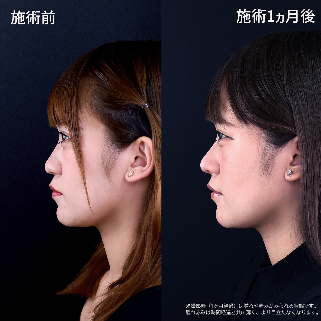 【鼻整形】鼻先に自然な丸みを残した、ナチュラル鼻尖形成