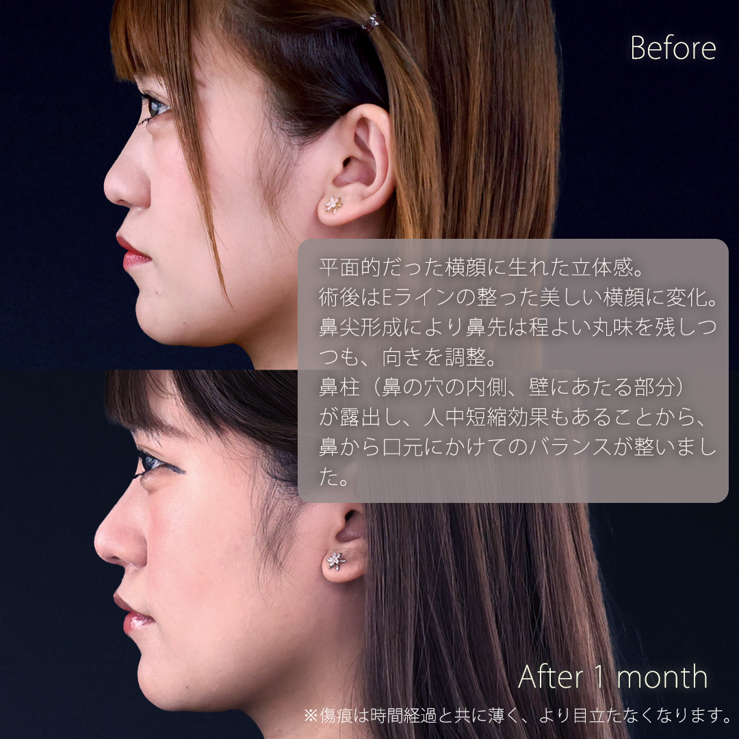 鼻先軟骨移植/鼻尖形成・鼻尖縮小の症例写真 施術前後 