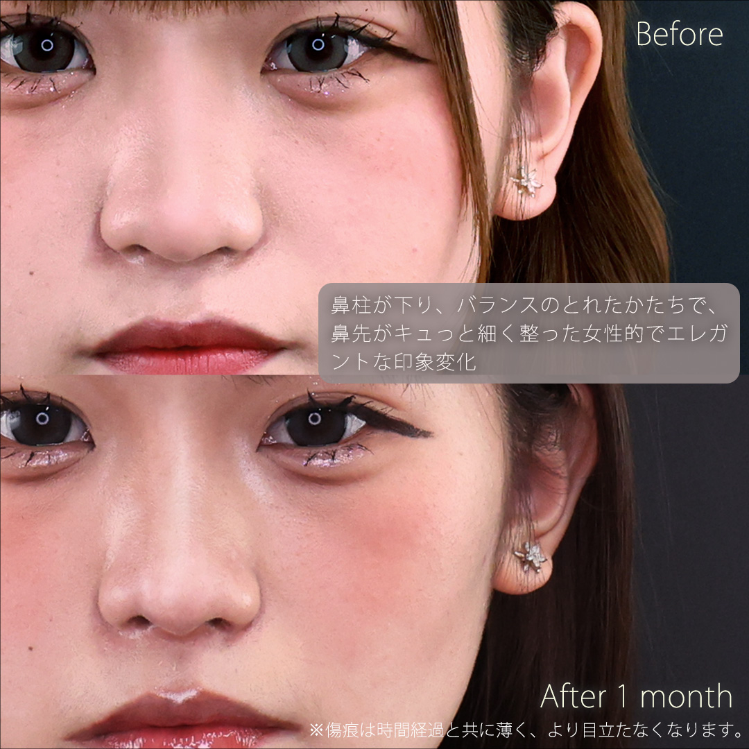 鼻先軟骨移植/鼻尖形成・鼻尖縮小の症例写真 施術前後 