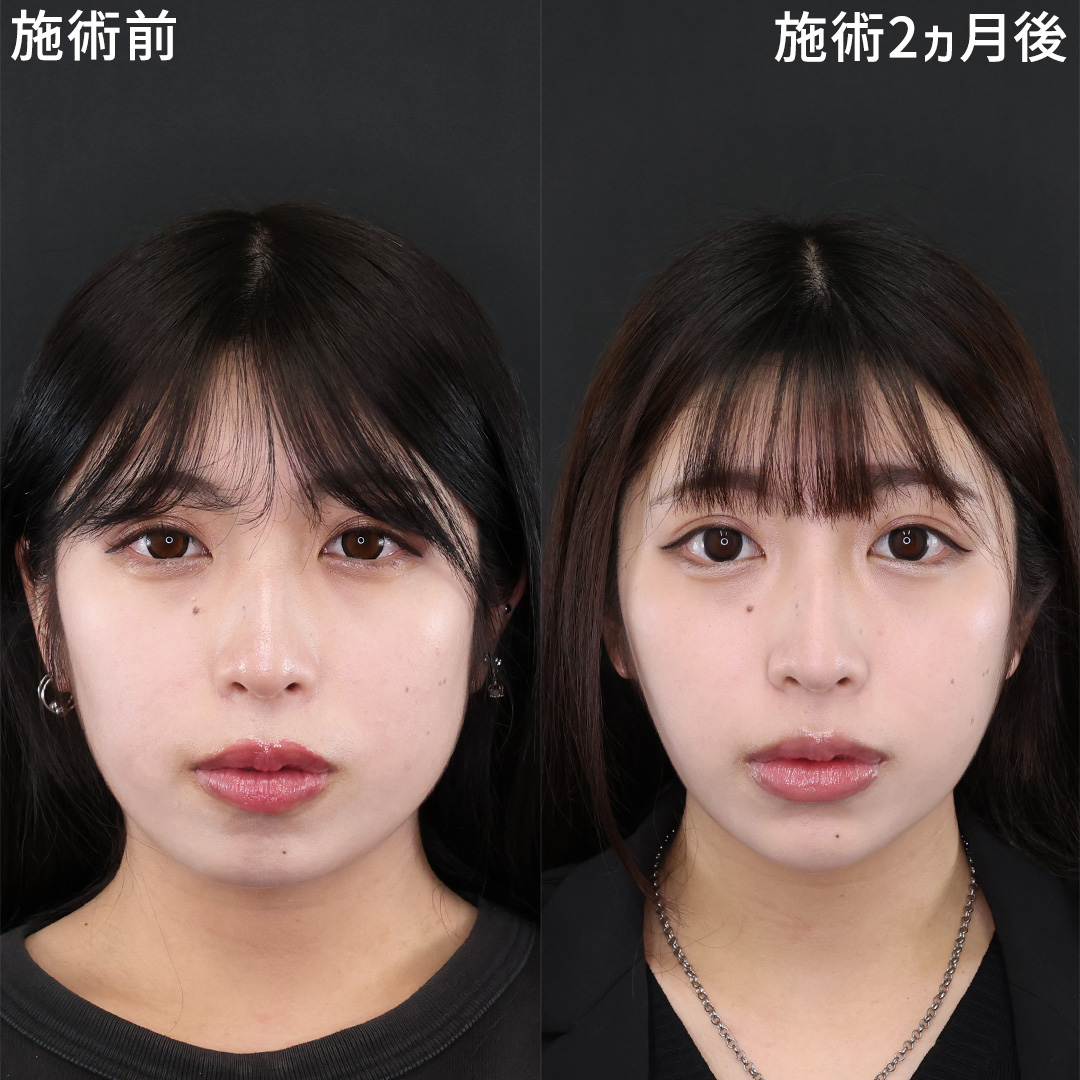 お顔のバランスを整える小顔整形