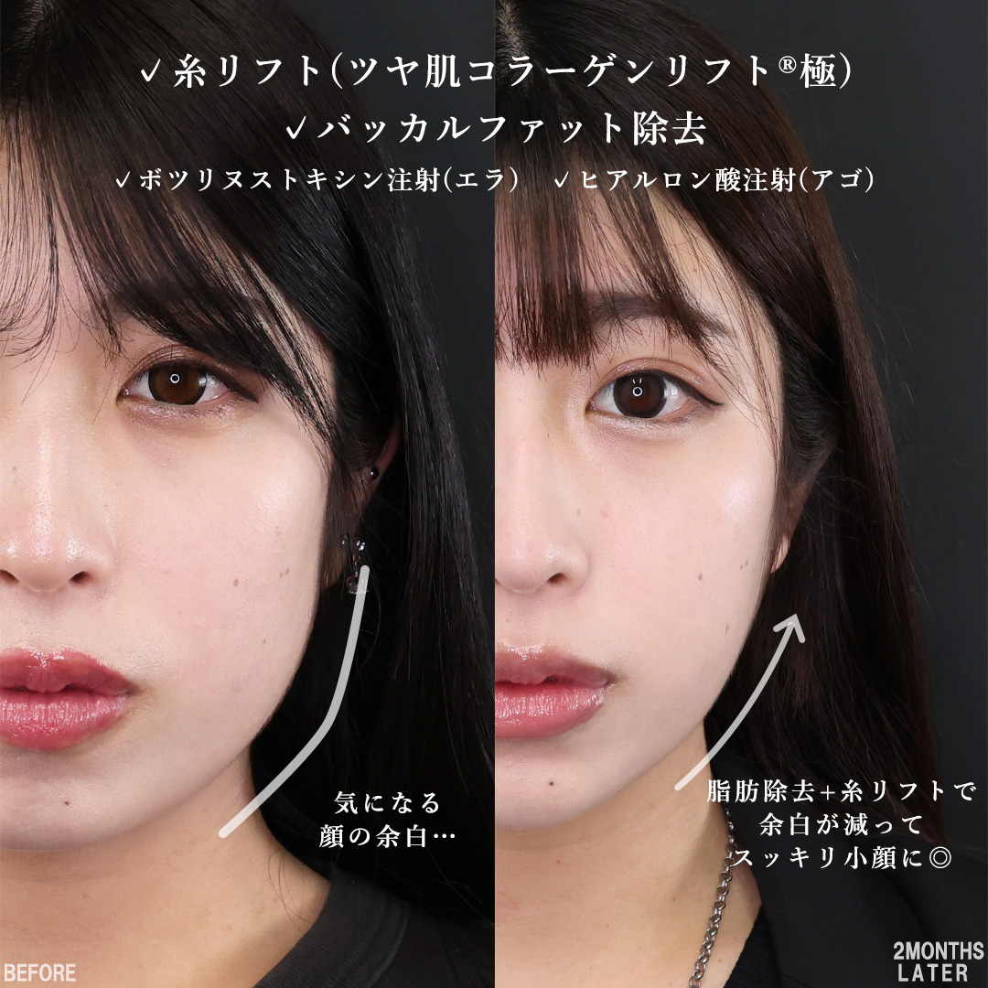 TAC式 ツヤ肌コラーゲンリフト®/バッカルファット除去/顎のヒアルロン酸注射の症例写真 施術前後 