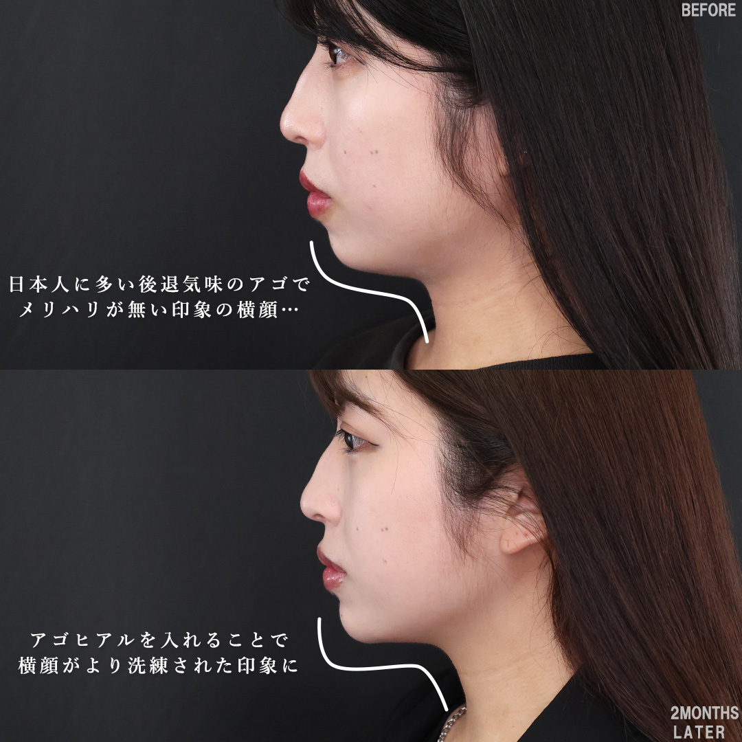 TAC式 ツヤ肌コラーゲンリフト®/バッカルファット除去/顎のヒアルロン酸注射の症例写真 施術前後 