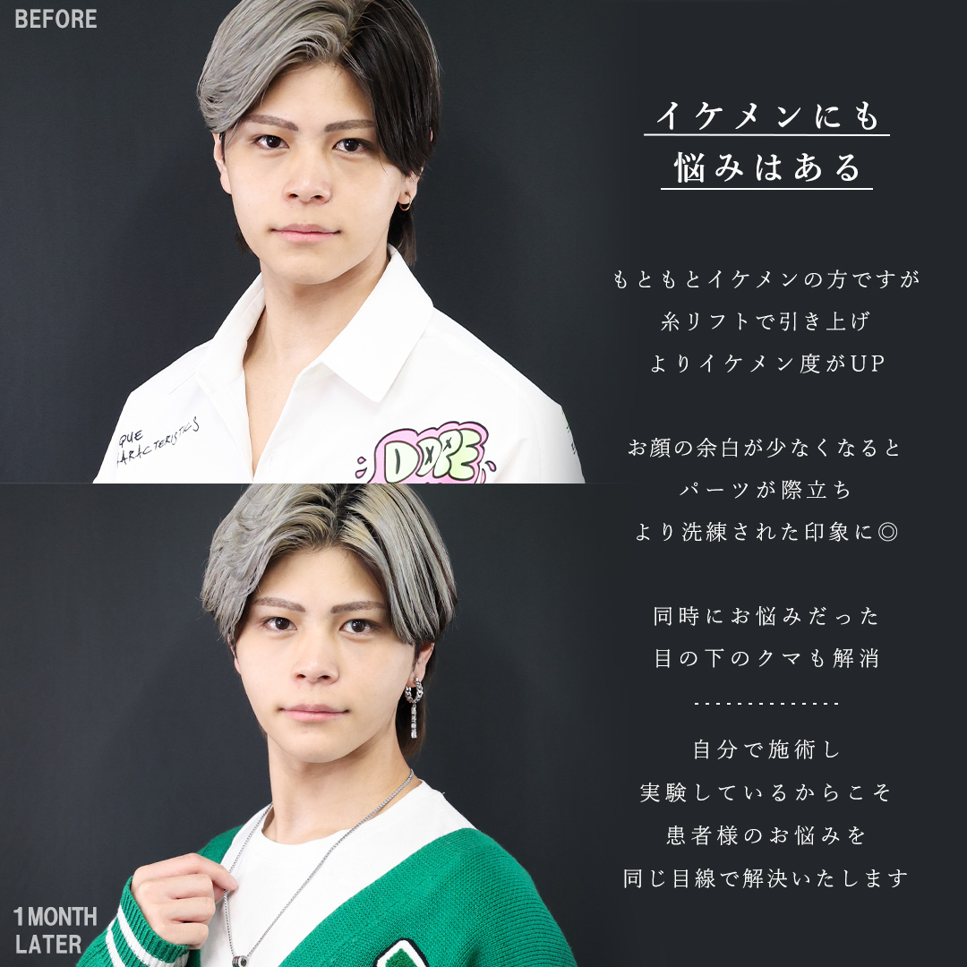 TAC式 ツヤ肌コラーゲンリフト®/下眼瞼脱脂術（目の下のたるみ取り・目の下の脂肪ふくらみ取り）/ゴルゴ線のヒアルロン酸注射の症例写真 施術前後 