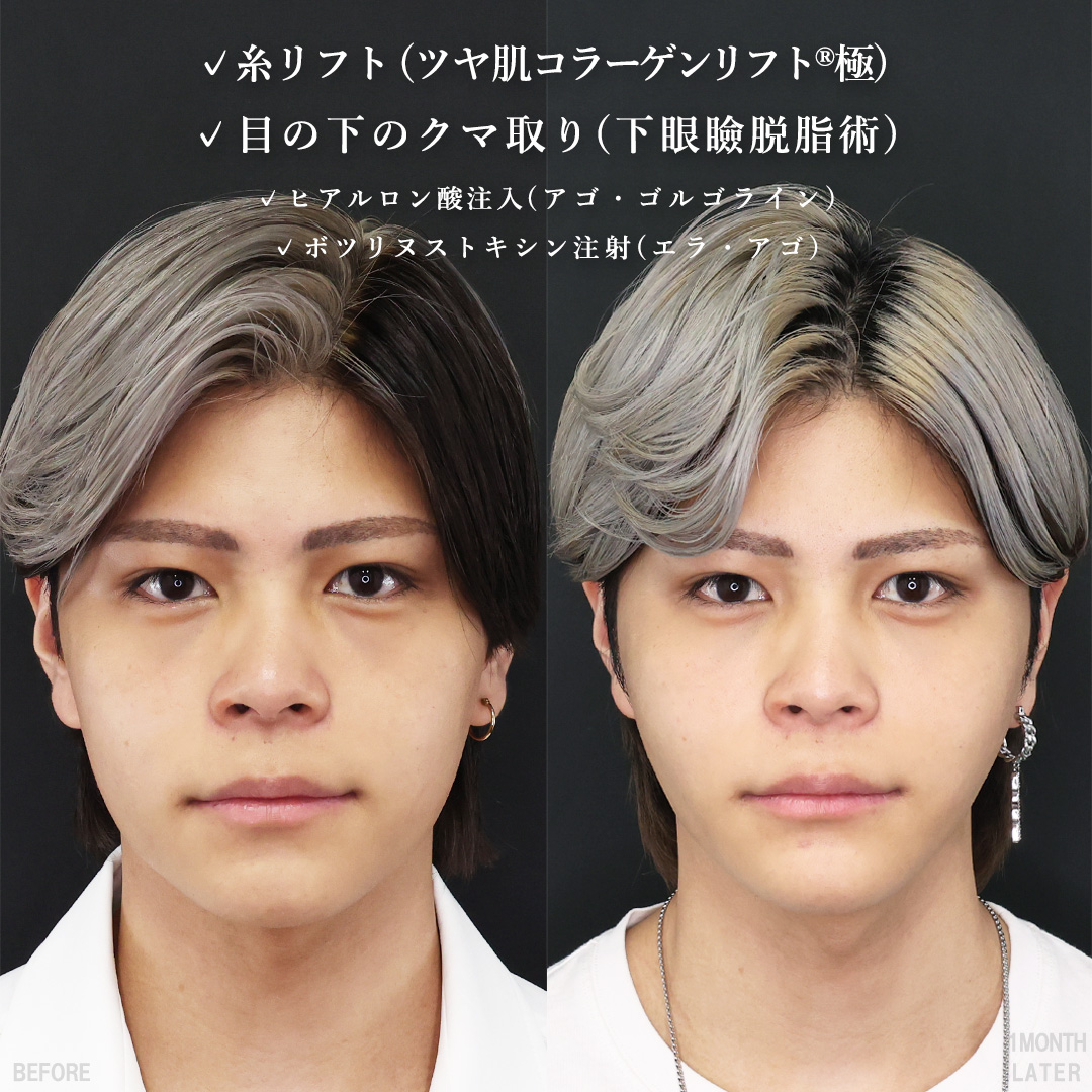 TAC式 ツヤ肌コラーゲンリフト®/下眼瞼脱脂術（目の下のたるみ取り・目の下の脂肪ふくらみ取り）/ゴルゴ線のヒアルロン酸注射の症例写真 施術前後 