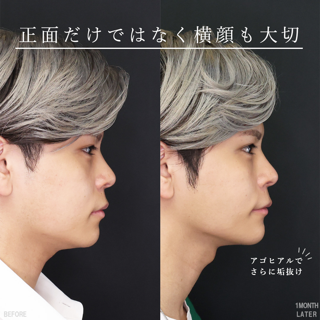 TAC式 ツヤ肌コラーゲンリフト®/下眼瞼脱脂術（目の下のたるみ取り・目の下の脂肪ふくらみ取り）/ゴルゴ線のヒアルロン酸注射の症例写真 施術前後 