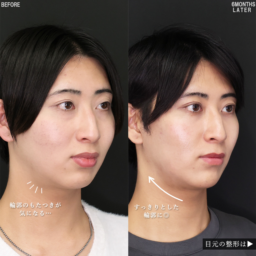 口唇縮小術/二重埋没法/下眼瞼脱脂術（目の下のたるみ取り・目の下の脂肪ふくらみ取り）の症例写真 施術前後 