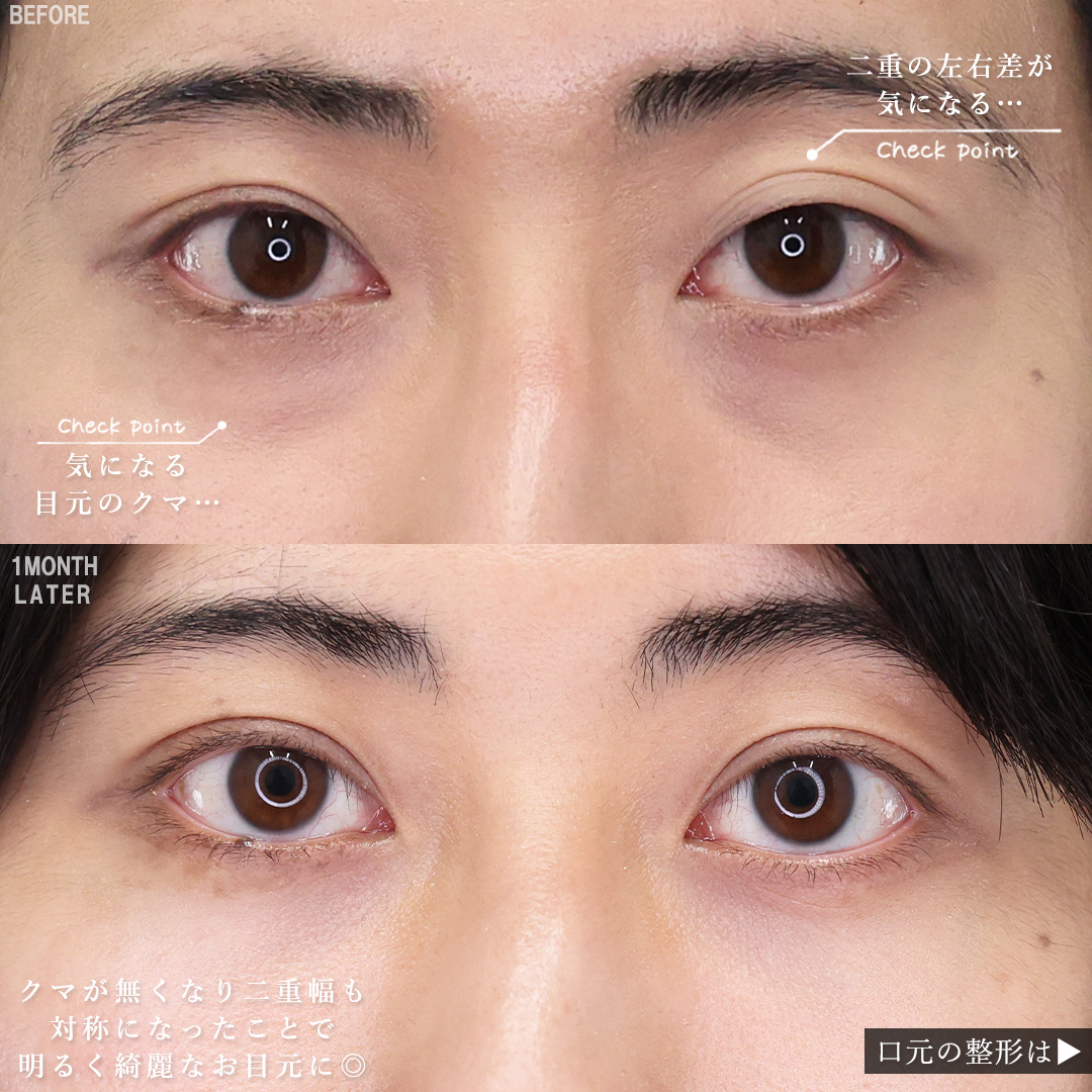 口唇縮小術/二重埋没法/下眼瞼脱脂術（目の下のたるみ取り・目の下の脂肪ふくらみ取り）の症例写真 施術前後 