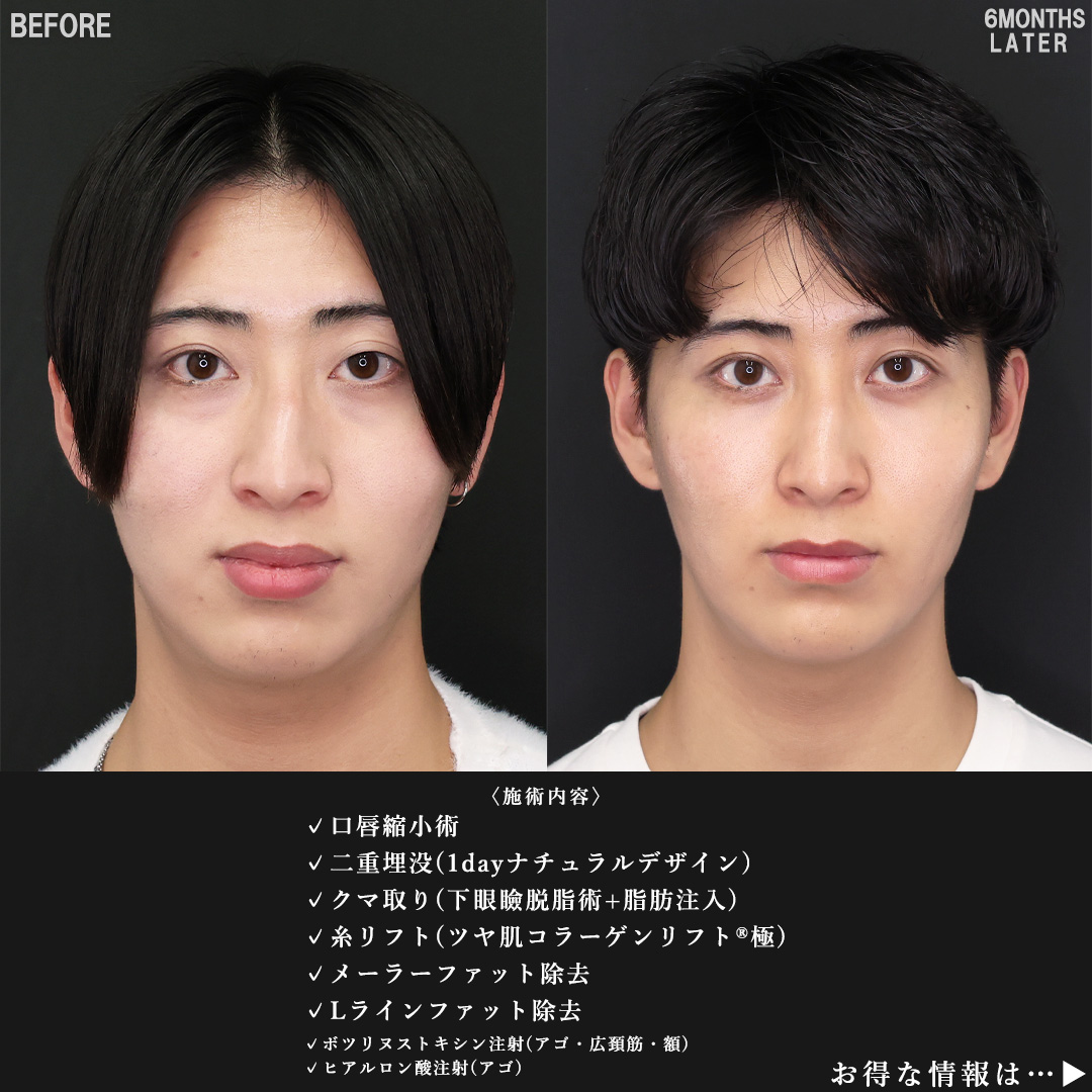 口唇縮小術/二重埋没法/下眼瞼脱脂術（目の下のたるみ取り・目の下の脂肪ふくらみ取り）の症例写真 施術前後 