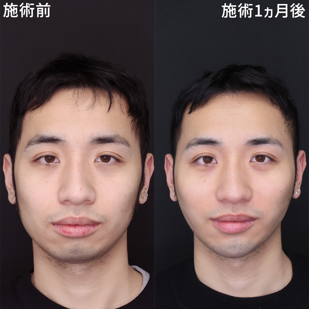 理想に近づく男の小顔整形