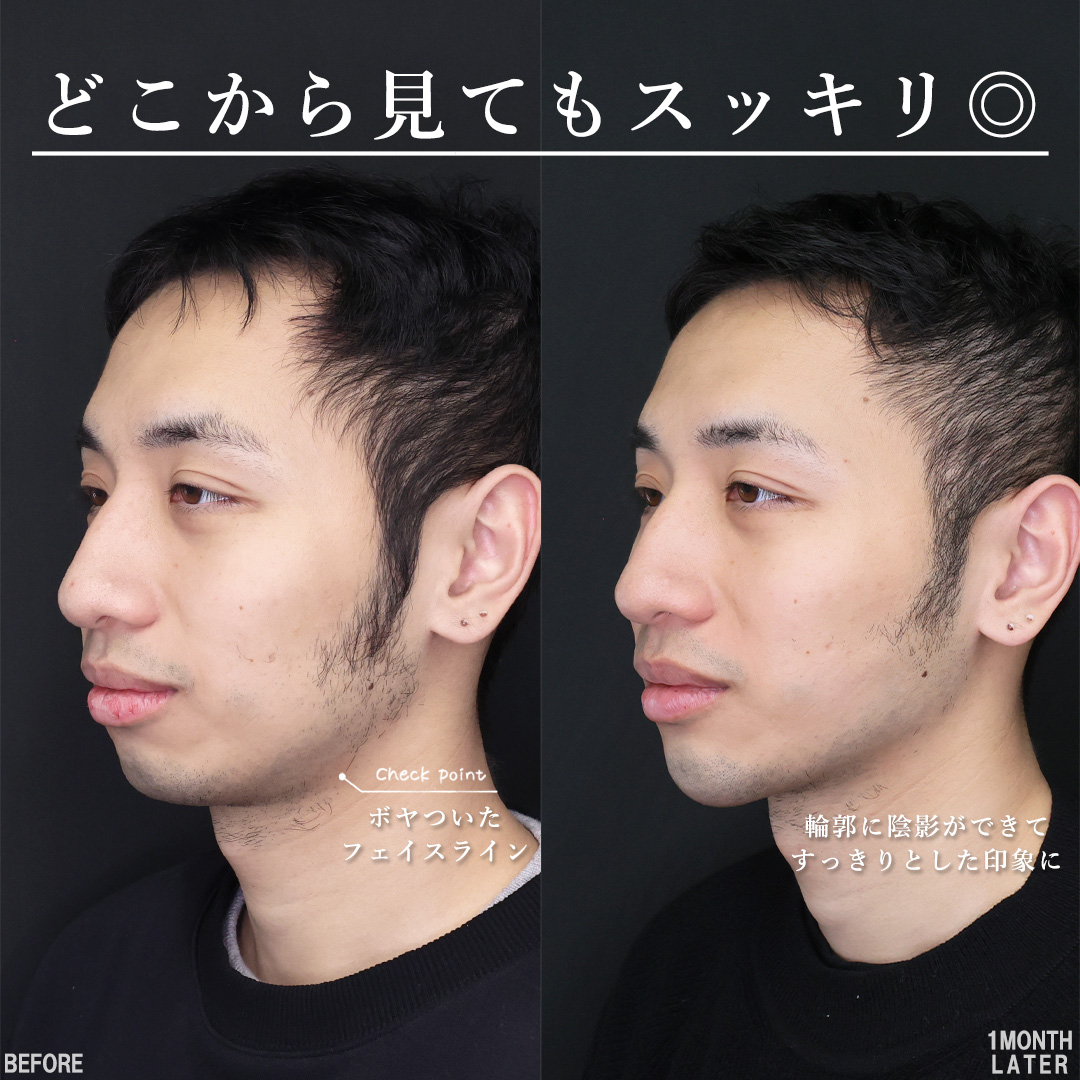 TAC式 ツヤ肌コラーゲンリフト®/顎のヒアルロン酸注射/エラボトックス注射の症例写真 施術前後 