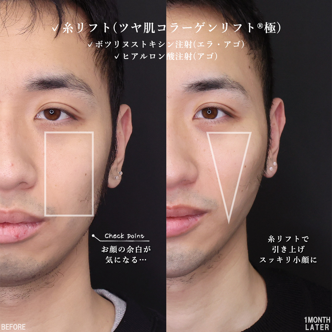 TAC式 ツヤ肌コラーゲンリフト®/顎のヒアルロン酸注射/エラボトックス注射の症例写真 施術前後 