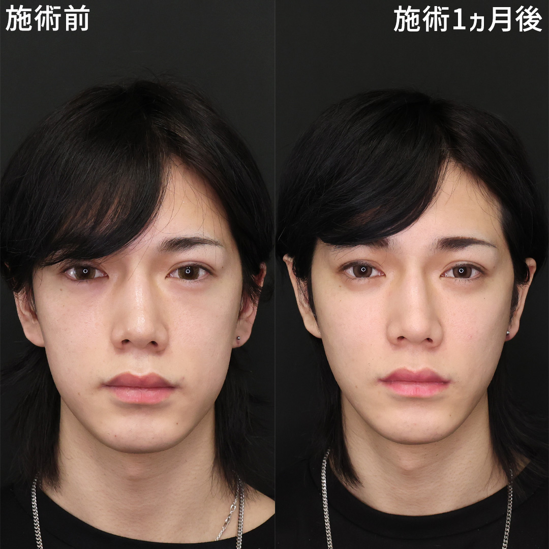 【糸リフト】イケメン度を上げるメンズ整形