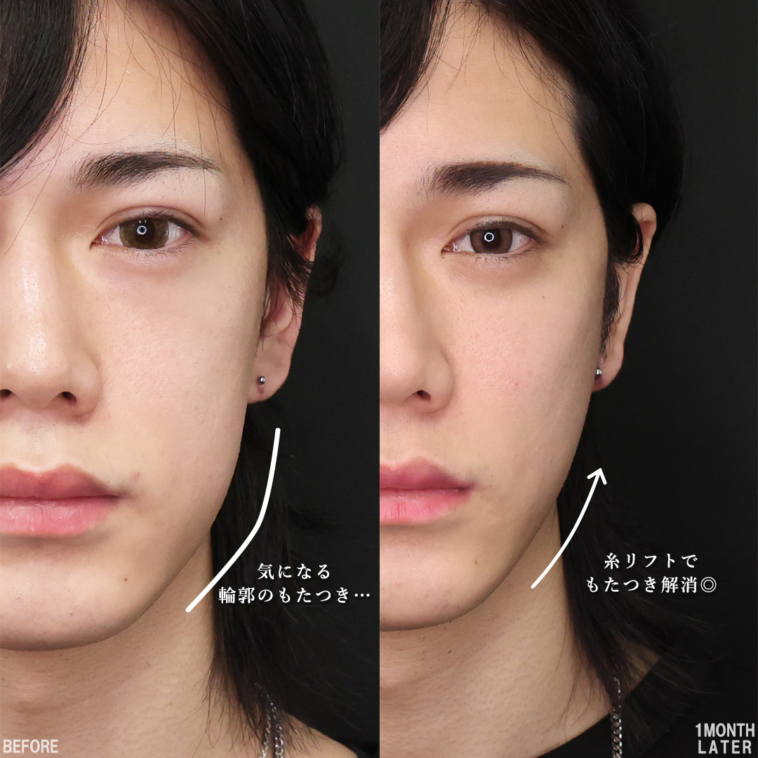 TAC式 ツヤ肌コラーゲンリフト®/下眼瞼脱脂術（目の下のたるみ取り・目の下の脂肪ふくらみ取り）/ゴルゴ線のヒアルロン酸注射の症例写真 施術前後 