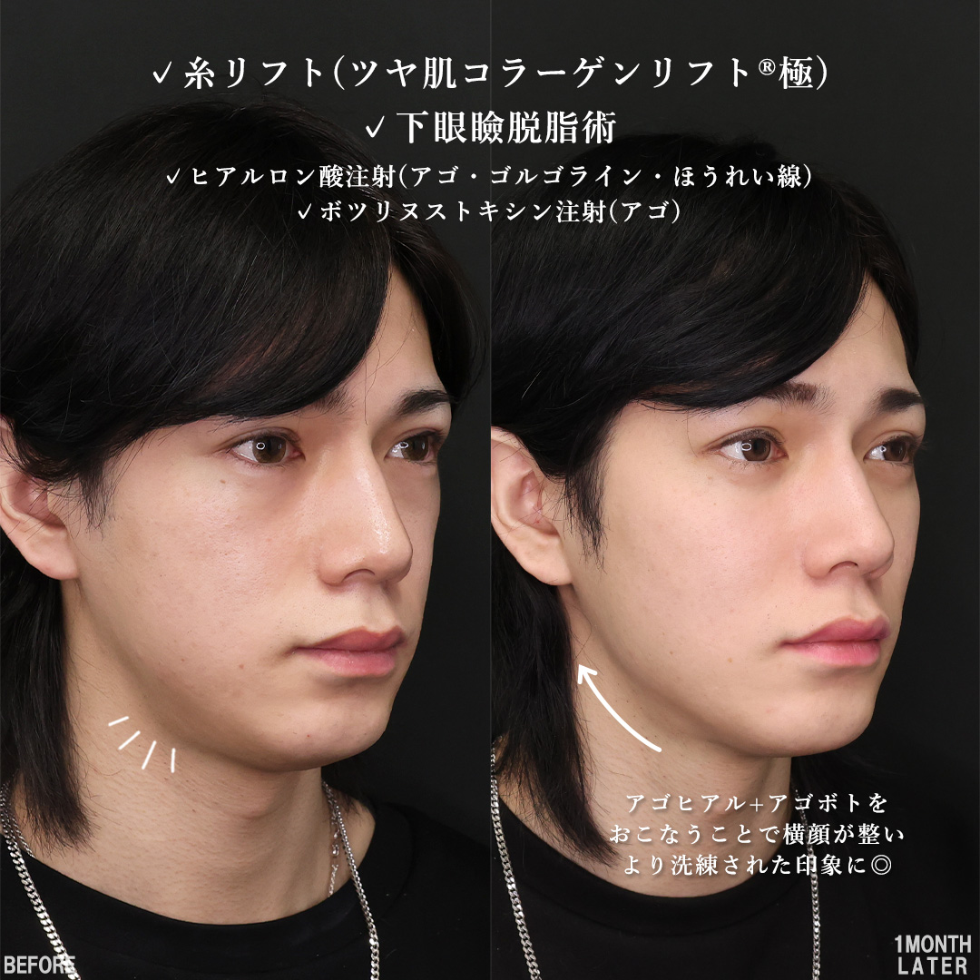 TAC式 ツヤ肌コラーゲンリフト®/下眼瞼脱脂術（目の下のたるみ取り・目の下の脂肪ふくらみ取り）/ゴルゴ線のヒアルロン酸注射の症例写真 施術前後 