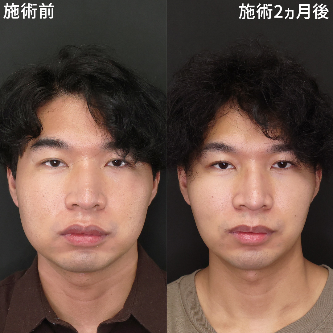 【脂肪吸引】垢抜けを叶えるメンズ小顔整形