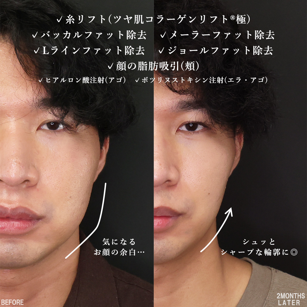 TAC式 ツヤ肌コラーゲンリフト®/メーラーファット除去/バッカルファット除去の症例写真 施術前後 