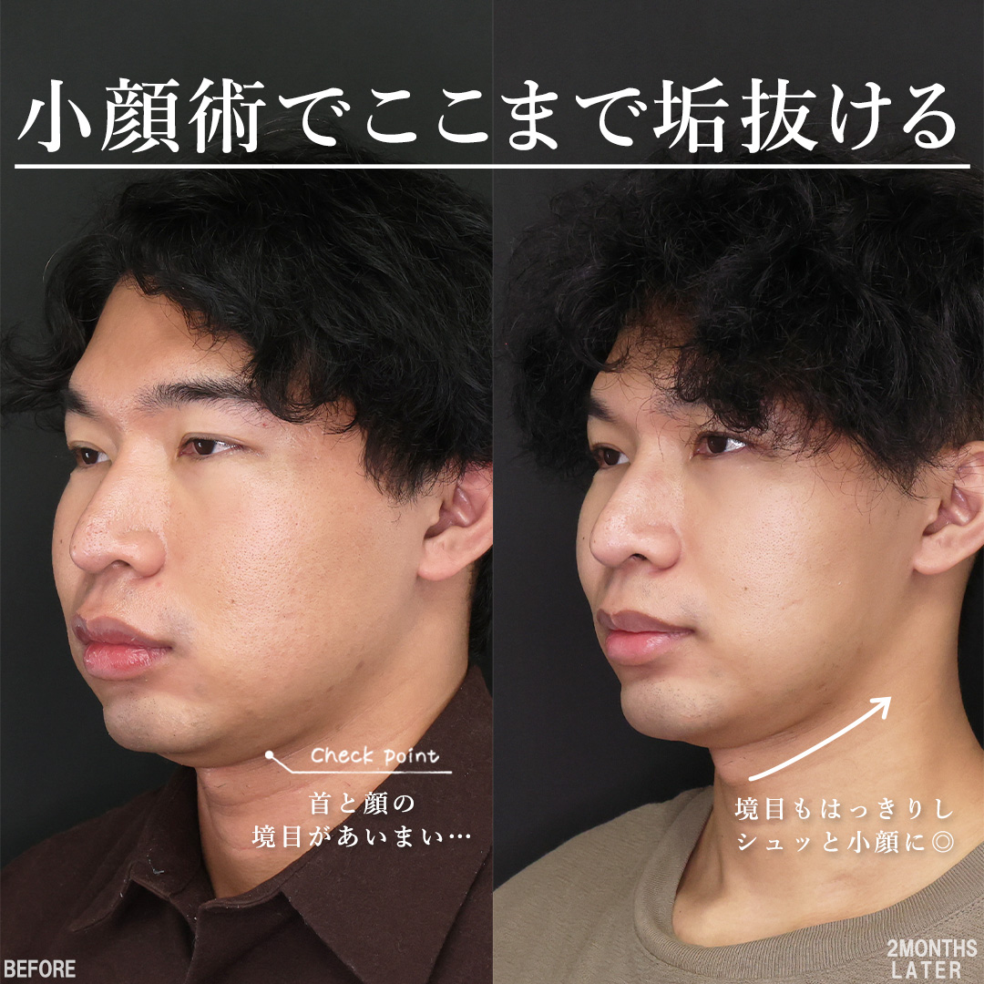 TAC式 ツヤ肌コラーゲンリフト®/メーラーファット除去/バッカルファット除去の症例写真 施術前後 