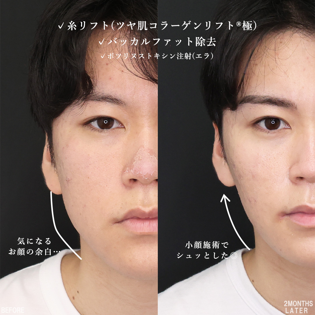TAC式 ツヤ肌コラーゲンリフト®/バッカルファット除去/エラボトックス注射の症例写真 施術前後 