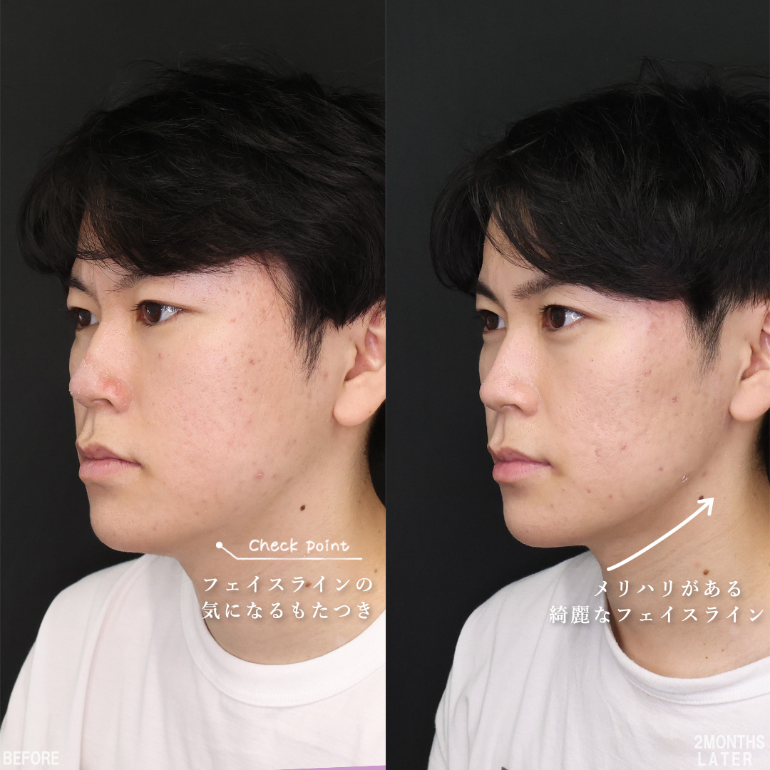 TAC式 ツヤ肌コラーゲンリフト®/バッカルファット除去/エラボトックス注射の症例写真 施術前後 