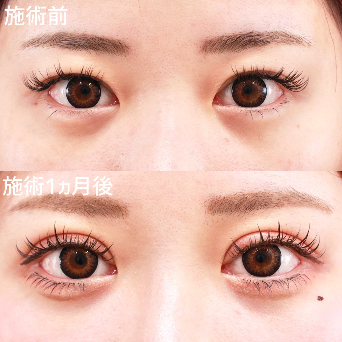 【二重全切開法】「切る二重整形」で半永久的な二重に！