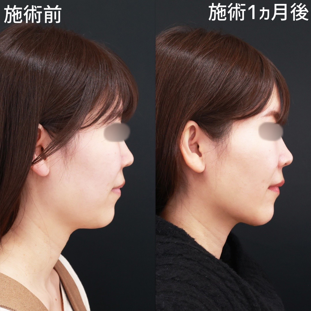 【顎下脂肪吸引×糸リフト極】クッキリと影が出るほど、美しく際立つフェイスラインに！