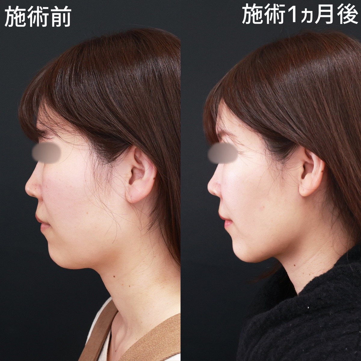 TAC式 ツヤ肌コラーゲンリフト®/顔の脂肪吸引/Lラインファット除去（エラ下脂肪除去）の症例写真 施術前後 