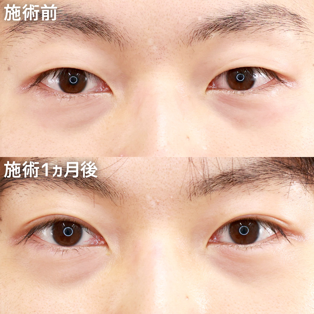 【メンズの二重整形】目の開きを良く見せ、自然に目元を大きく