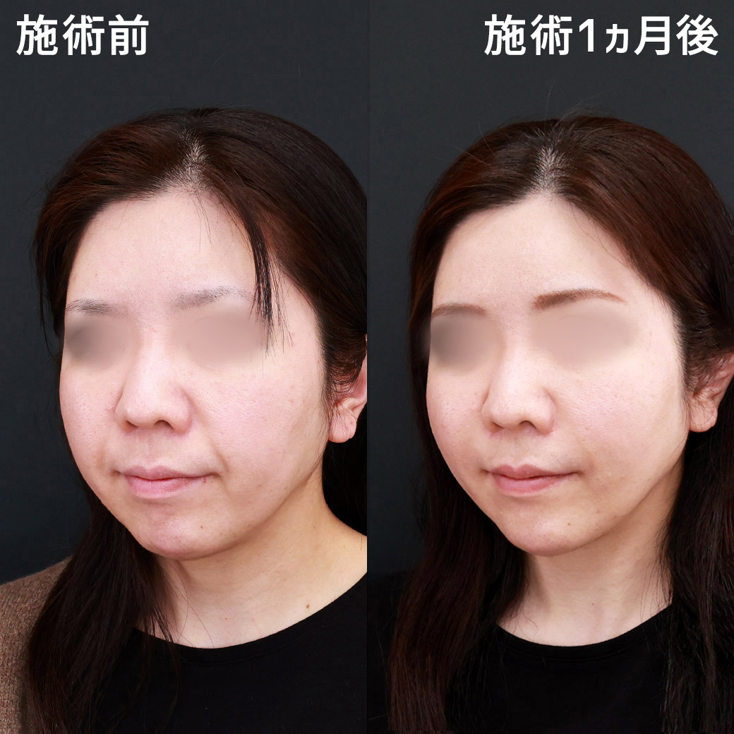 TAC式 ツヤ肌コラーゲンリフト®/ジョールファット除去/ほうれい線のヒアルロン酸注射の症例写真 施術前後 